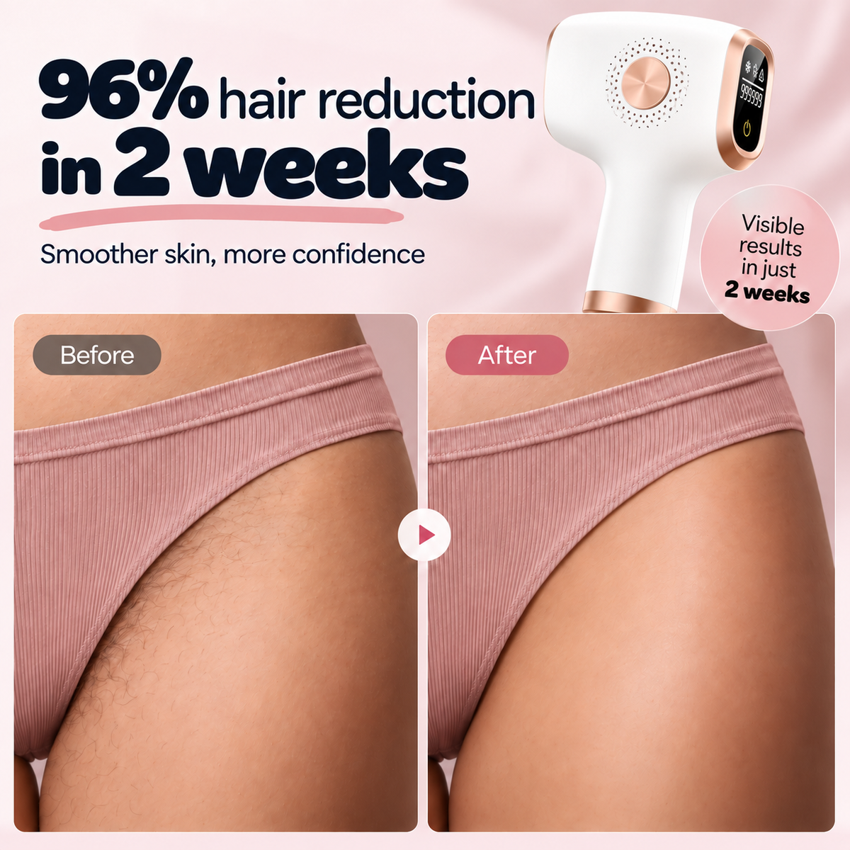 IPL Ice Cooling Laser Hair Removal Handset Permanently